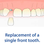Replacement of a single front tooth